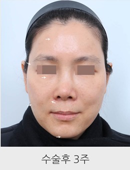 -韩国星愿整形外科真人脂肪填充术后三周恢复情况、图片分享