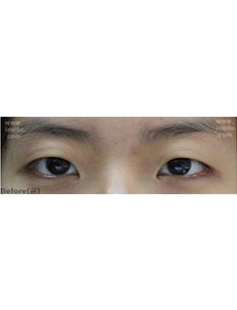韩国IOU医院眼部整形术前术后14天对比照，变化太大了！