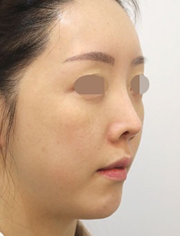 在韩国星愿整形做了鼻部矫正，术后鼻子太漂亮了！