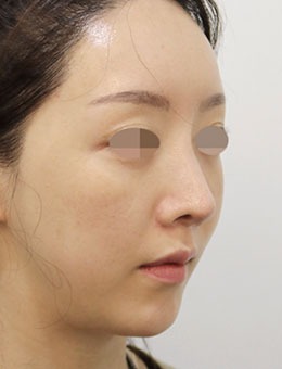 在韩国星愿整形做了鼻部矫正，术后鼻子太漂亮了！_术后