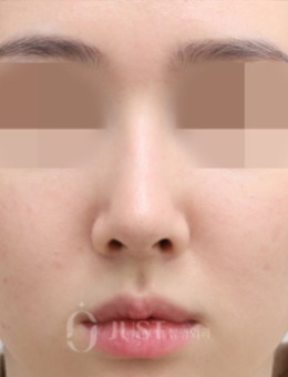 韩国just整形做鼻修复手术照片，只用真皮做移植就有理想效果！_术后