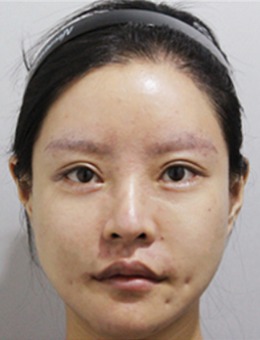 在韩国宝士丽医院做完全脸脂肪移植和超声刀之后年轻不止一点点！