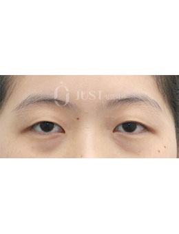 -在韩国Just整形做了眼型矫正+眼下脂肪重排手术，术后眼睛太美了！