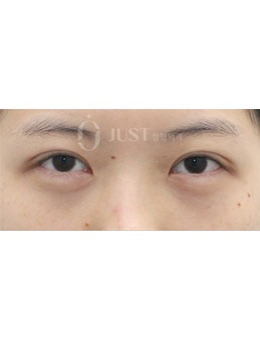 -在韩国Just整形做了眼型矫正+眼下脂肪重排手术，术后眼睛太美了！