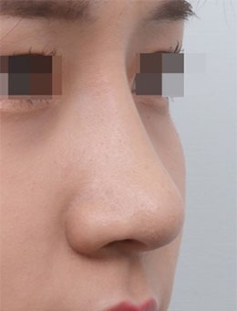 一组对比图说明，韩国星愿整形驼峰鼻矫正技术不一般！