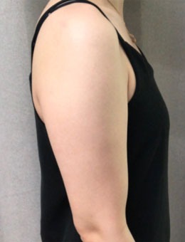 韩国宝士丽医院手臂环吸术前术后2个月对比，术后手臂线条很优美！