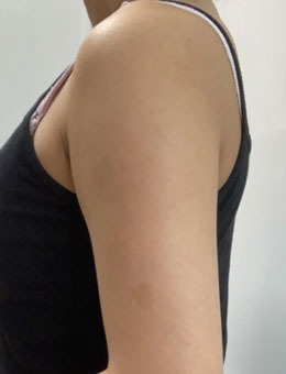 在韩国宝士丽医院做了胳膊环吸+副乳+肩胛骨吸脂术，术后身材太美了！_术前