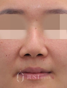 -韩国JUST整形鼻修复术前术后对比图，术后鼻型精致小巧！