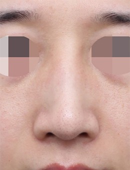 -韩国星愿整形外科鼻部整形，侧面正面都可以很美！