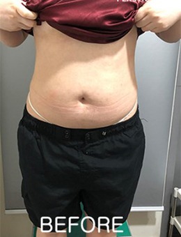 在韩国宝士丽医院腹部吸脂，大肚婆变身小蛮腰！
