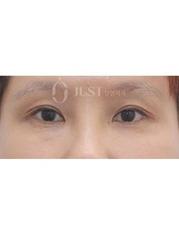 在韩国JUST整形做了眼皮细微脂肪移植手术，看起来年轻了很多！