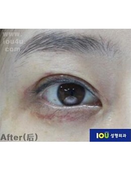 -双眼皮过宽疲惫感满满，韩国IOU整形外科修复自然！