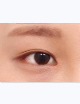 在韩国星愿整形做非切开双眼皮一个月恢复效果图片成这样..._术后