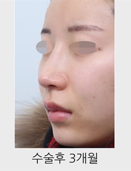 韩国星愿整形外科驼峰鼻矫正前后图片分享，对比疗效显著~_术后