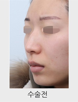 韩国星愿整形外科驼峰鼻矫正前后图片分享，对比疗效显著~_术前