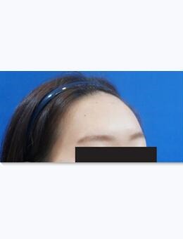 眉毛移植手术效果怎么样？韩国毛理女性眉毛移植图片曝光