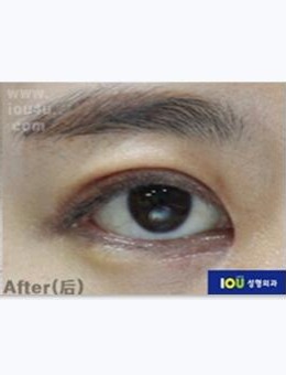 双眼皮过高眼睑下垂修复加开眼角有用吗？恢复过程图疗效一览_术后