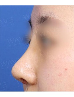 韩国WAVE整形外科鼻整形，术后美观度和鼻功能都恢复了！