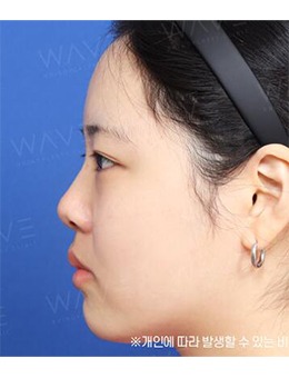选择韩国WAVE整形外科鼻整形，从短塌鼻变身小翘鼻！_术前