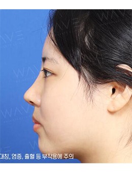 -选择韩国WAVE整形外科鼻整形，从短塌鼻变身小翘鼻！