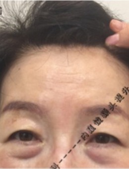 -韩国UcanB整形外科内窥镜额头提升+下眼睑手术整形真人经历分享！