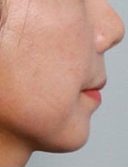 韩国迷你拉皮术后一周，法令纹鼻唇沟都不见了！_术后