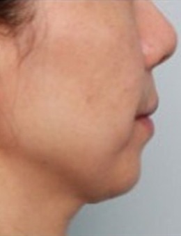 韩国迷你拉皮术后一周，法令纹鼻唇沟都不见了！_术前