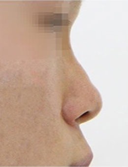 -驼峰鼻矫正案例对比图，术前术后变化超明显！