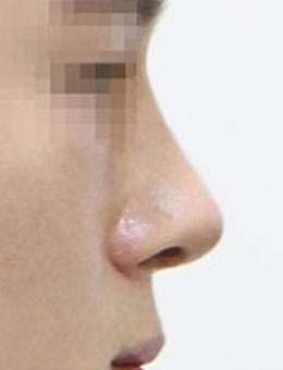 -驼峰鼻矫正案例对比图，术前术后变化超明显！