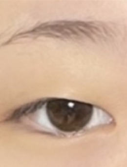 韩国VG整形外科双眼皮手术+眼睑矫正术+前开眼角术前后对比