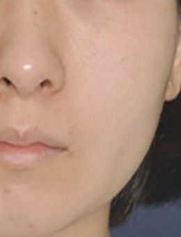 韩国4月31日整形外科颧骨缩小+下颌角削骨手术前后对比_术前
