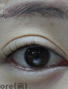 -双眼皮修复术后14天太自然了，韩国IOU医院的眼修复技术真厉害！
