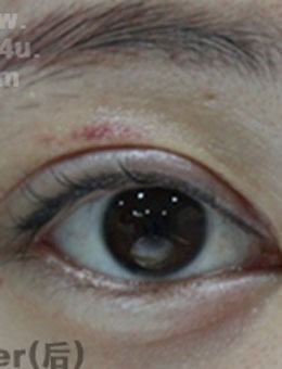 双眼皮修复术后14天太自然了，韩国IOU医院的眼修复技术真厉害！_术后
