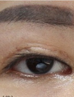 韩国IOU整形外科双眼皮修复术，恢复后犹如妈生款！
