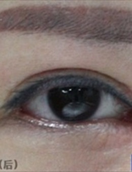 -韩国IOU整形外科双眼皮修复术，恢复后犹如妈生款！