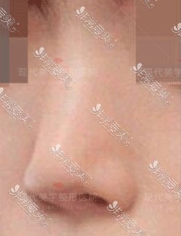韩国现代美学鼻梁+鼻尖+鼻小柱+鼻翼术后9天恢复变化！_术前