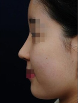 韩国will整形外科医院隆鼻+面部自体脂肪填充效果很厉害么_术后
