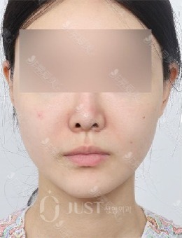 韩国JUST整形外科面部轮廓提升正面、45°、侧面疗效图片曝光_术前