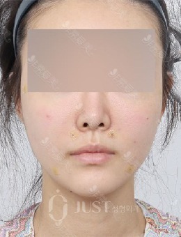 韩国JUST整形外科面部轮廓提升正面、45°、侧面疗效图片曝光_术后