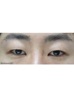  韩国IOU医院双眼皮+眼睑下垂矫正术前术后10天对比，特别美！_术前
