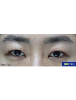  韩国IOU医院双眼皮+眼睑下垂矫正术前术后10天对比，特别美！_术后