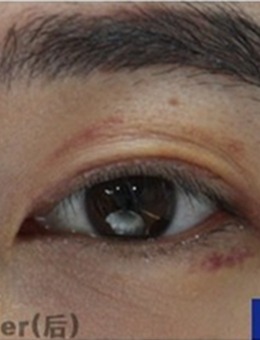 双眼皮改单眼皮+眼睑下垂修复成功术前术后图片曝光~