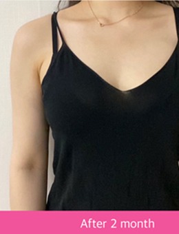 韩国宝士丽医院手臂+副乳+腋下+锁骨抽脂效果图片恢复期分享~