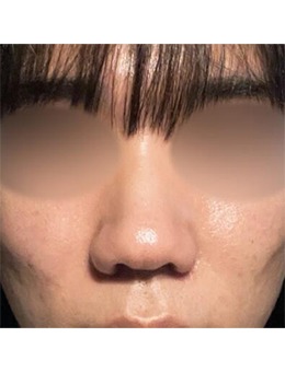 韩国乐日lara整形外科3d打印隆鼻+鼻头缩小+鼻小柱矫正，术后满分！
