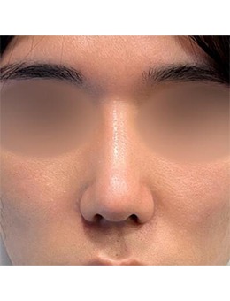 -韩国乐日lara整形外科3d打印隆鼻+鼻头缩小+鼻小柱矫正，术后满分！