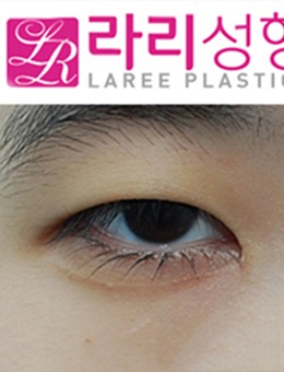 韩国来丽整形双眼皮+开眼角手术照片_术前