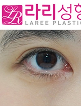 韩国来丽整形双眼皮+开眼角手术照片