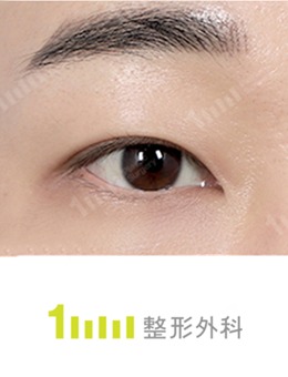 韩国1mm整形双眼皮手术+眼提肌矫正对比照