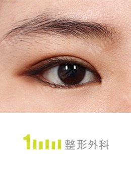 韩国1mm整形肿泡眼手术前后对比照