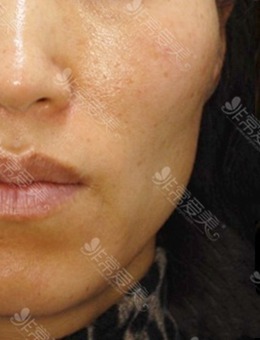 韩国DOCTORS皮肤科好吗？脸部棱角、面部凹陷怎么改善案例解析！